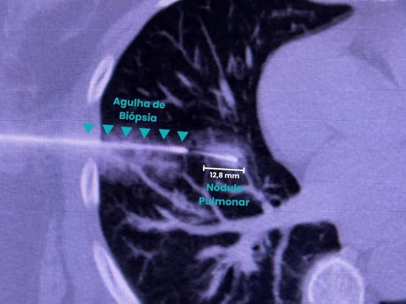 Tudo Que Você Precisa Saber Sobre Biópsia Guiada e Diagnóstico Preciso