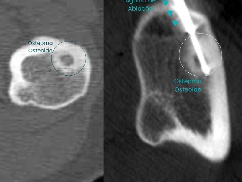 Tudo Que Você Precisa Saber Sobre Ablação por Radiofrequência de Osteoma Osteoide