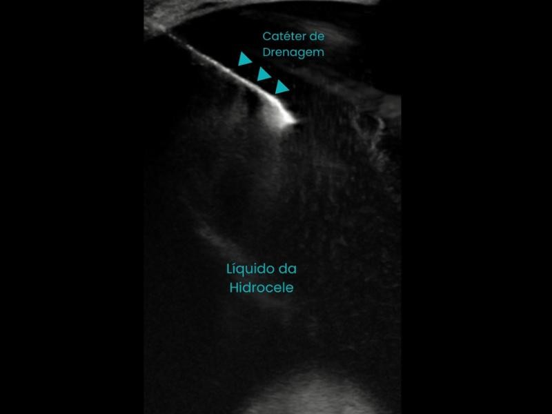 Saiba Tudo Sobre as Principais Dúvidas sobre Esclerose de Hidrocele