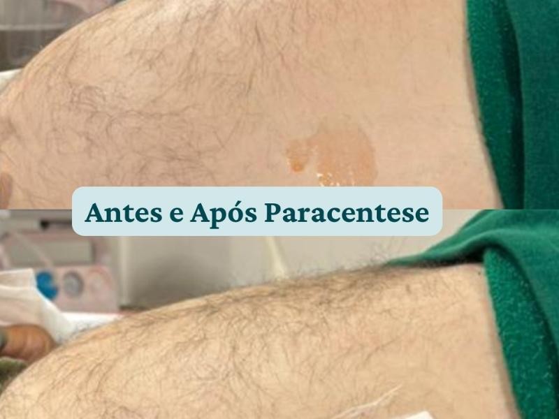 Saiba Tudo Sobre os Benefícios da Paracentese Guiada Por Imagem